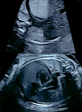 The Evolving Paradigm of Prenatal Therapy for Cystic Fibrosis